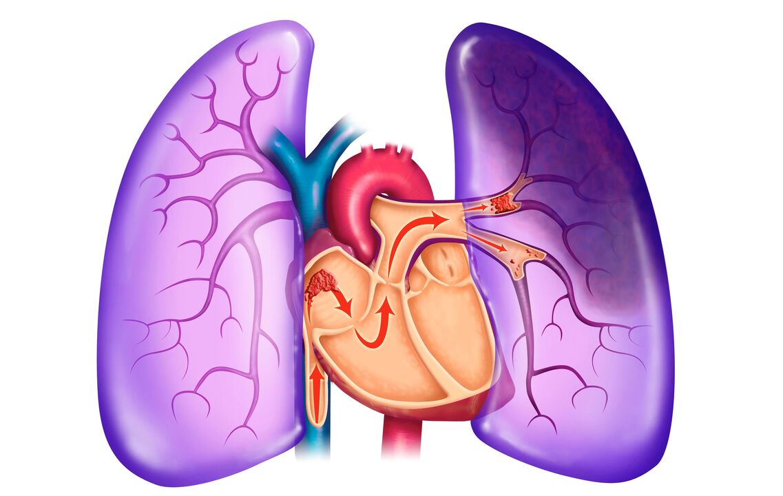 hypertension pulmonaire